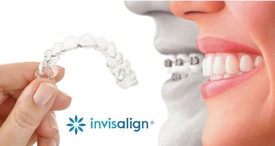 10 dúvidas sobre Invisalign respondidas aqui! - SNG Odontologia
